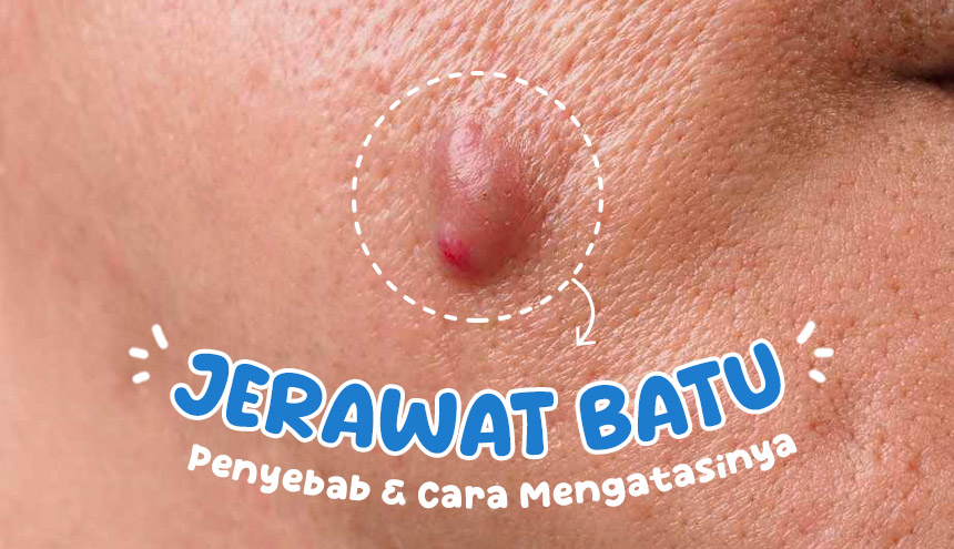 CATAT! Ini Penyebab dan Cara Ampuh Hilangkan Jerawat Batu