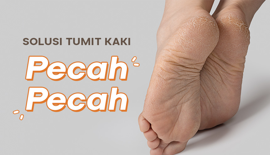 Kulit Kaki Pecah-Pecah? Ini dia Solusi Alaminya