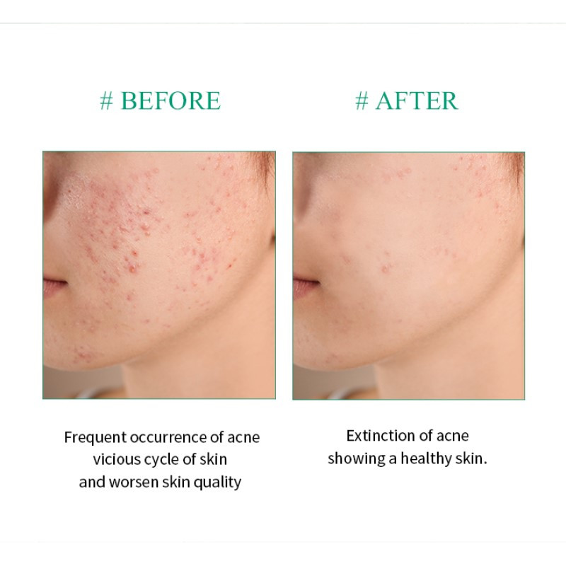 Jual Breylee Tea Tree Acne Treatment Cream Termurah April 2024 | BeautyHaul